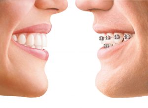 invisalign a zwykłe aparaty ortodontyczne