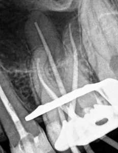 Endodoncja Chorzów