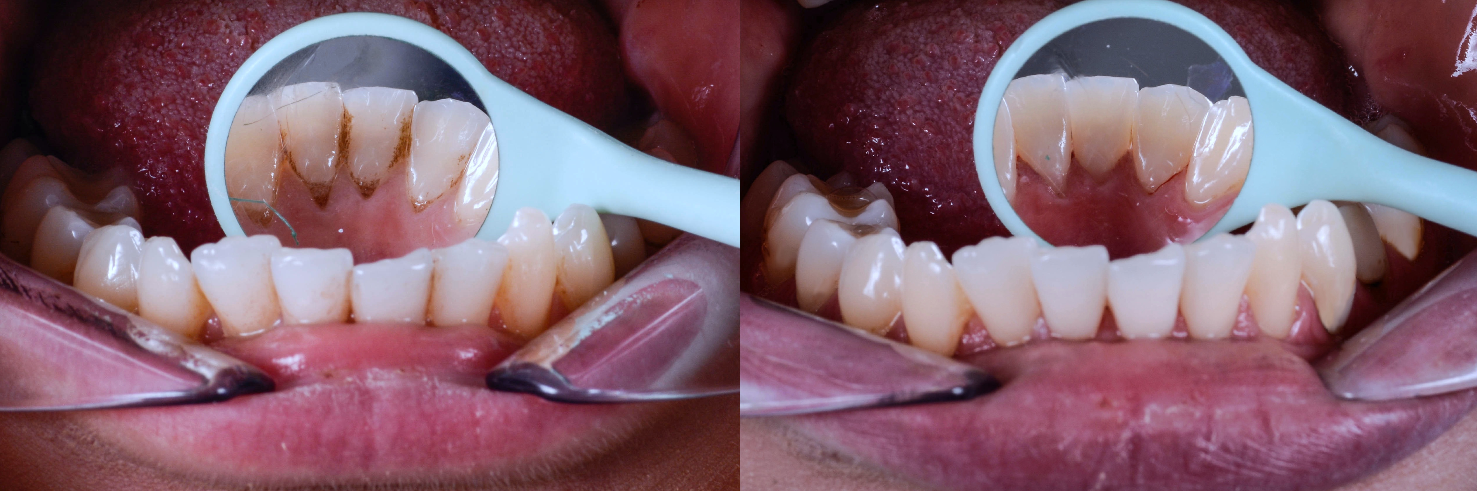 Higienizacja zębów przed i po